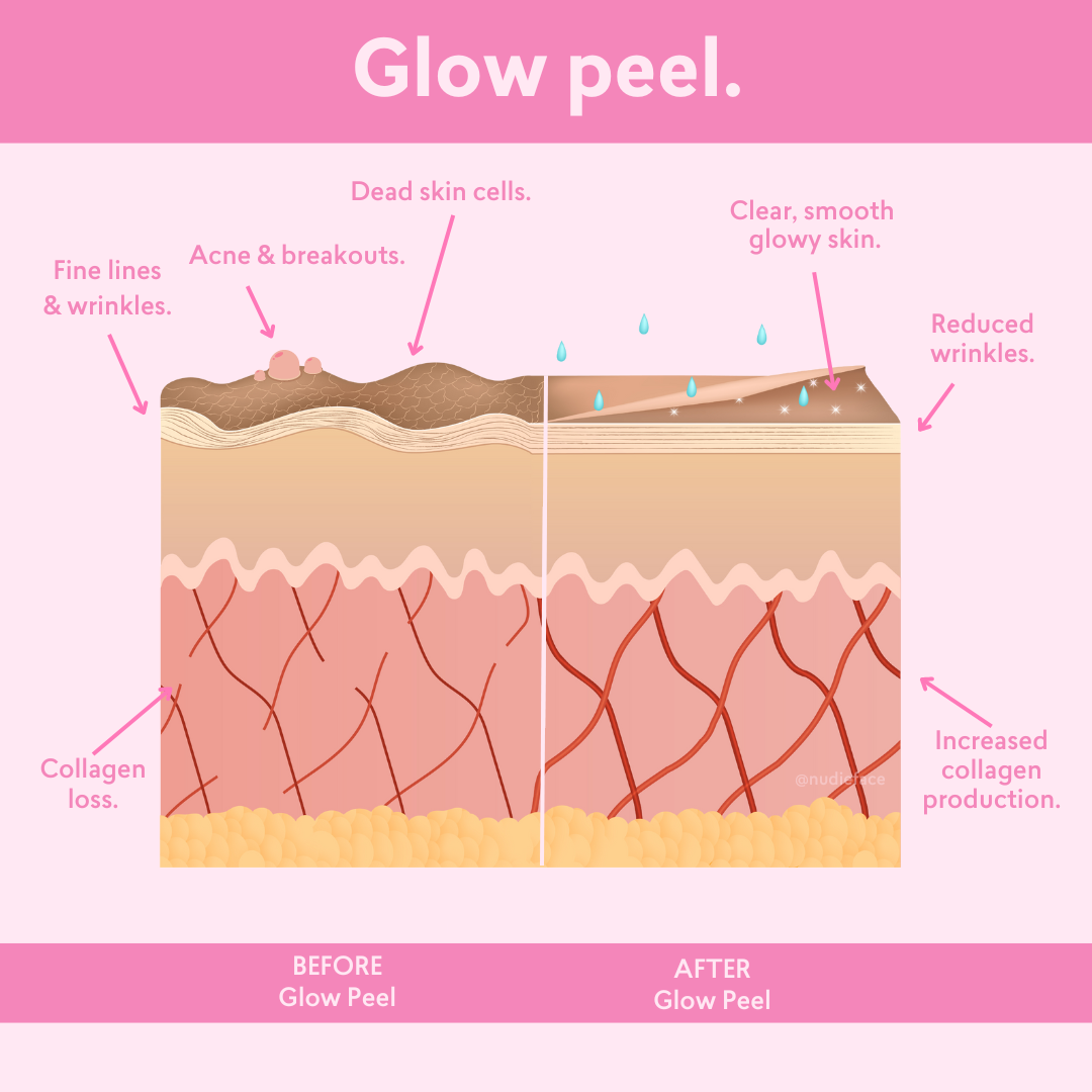 Glow Peel - At Home Chemical Peel