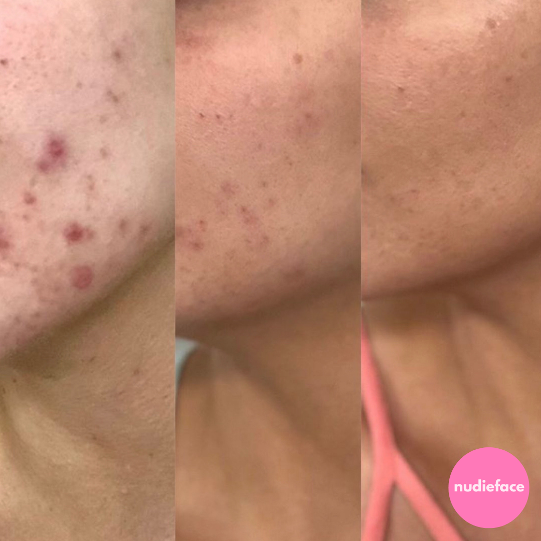 Glow Peel - At Home Chemical Peel