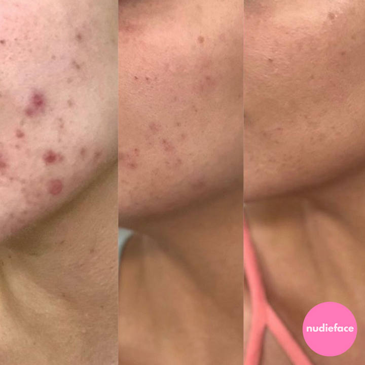 Glow Peel - At Home Chemical Peel