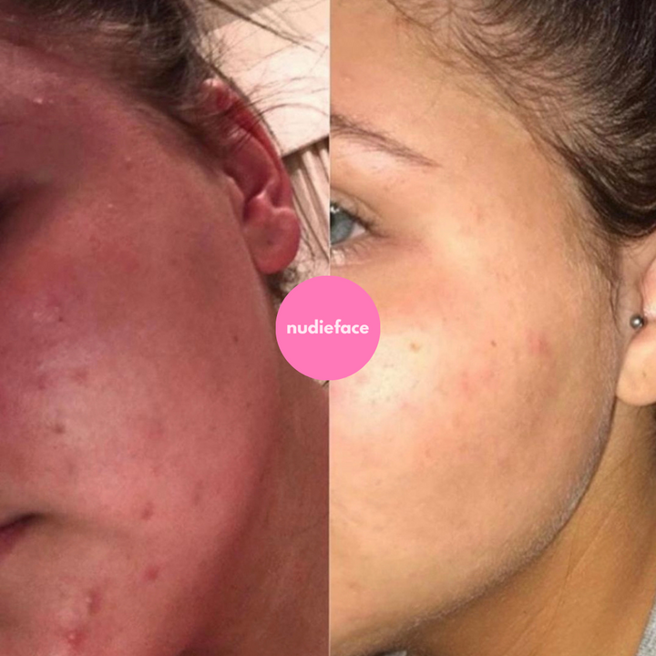 Glow Peel - At Home Chemical Peel