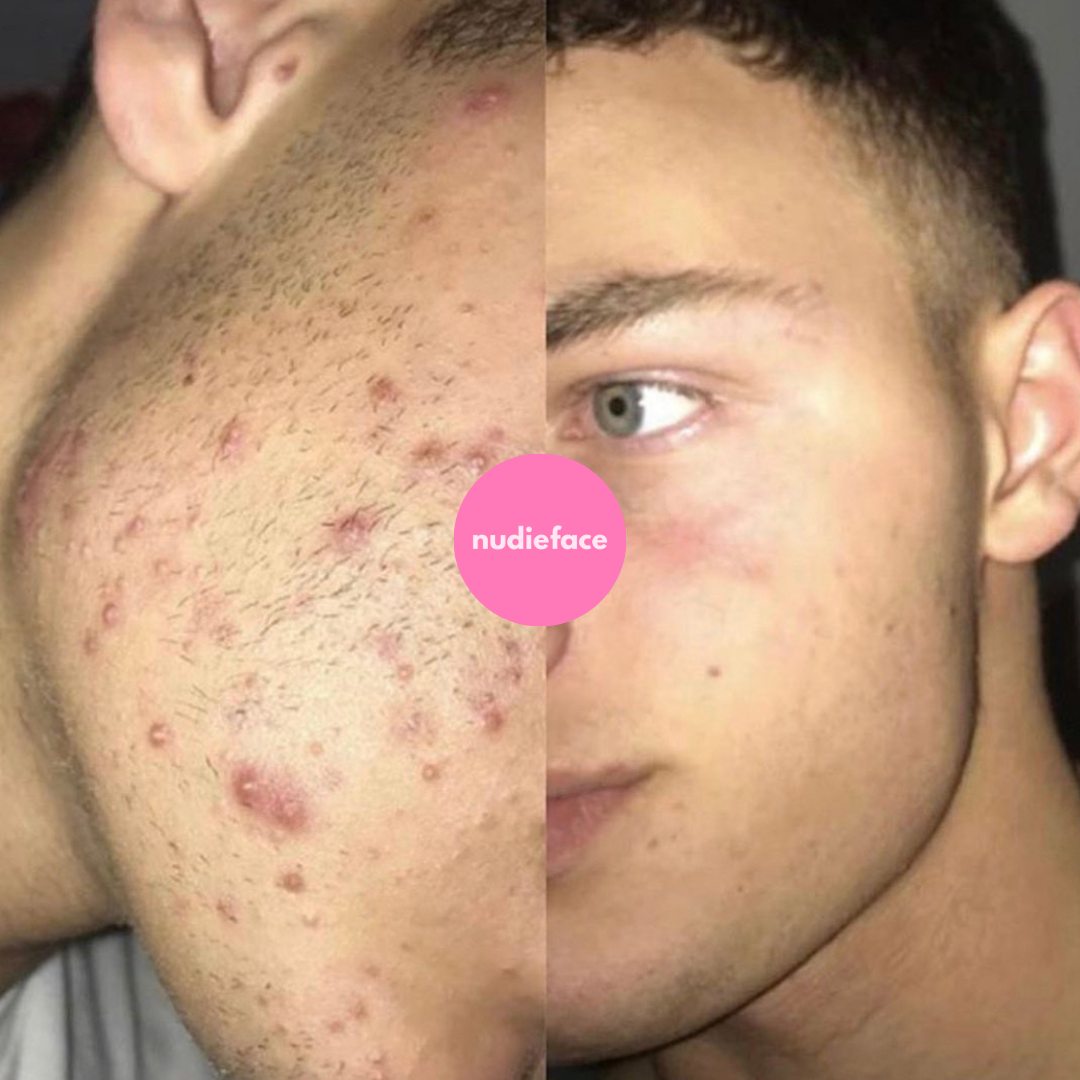 Glow Peel - At Home Chemical Peel
