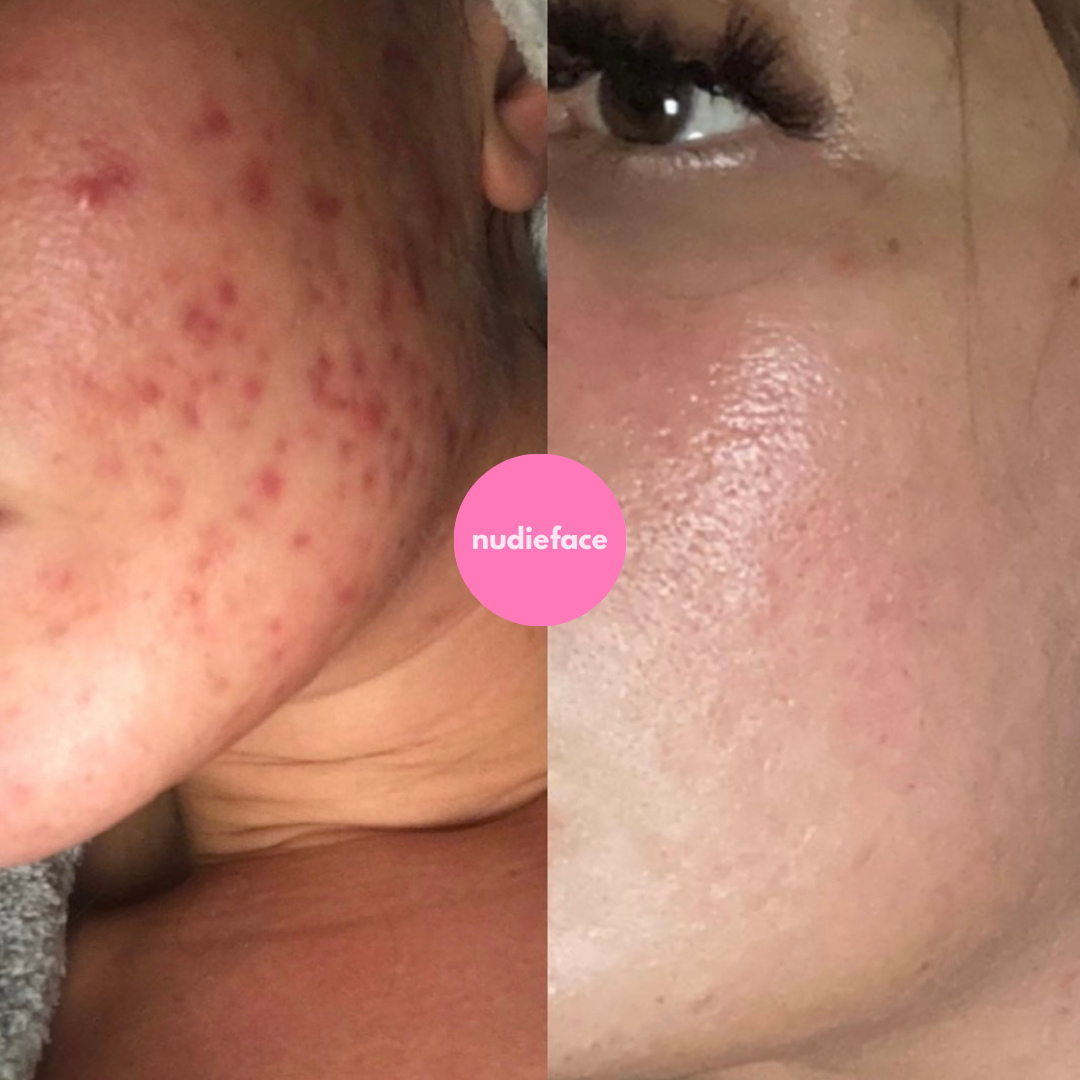 Glow Peel - At Home Chemical Peel