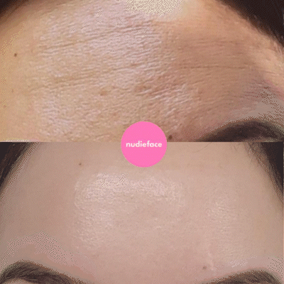 Notox - Forehead + Frown Lines Silicone Wrinkle Patch