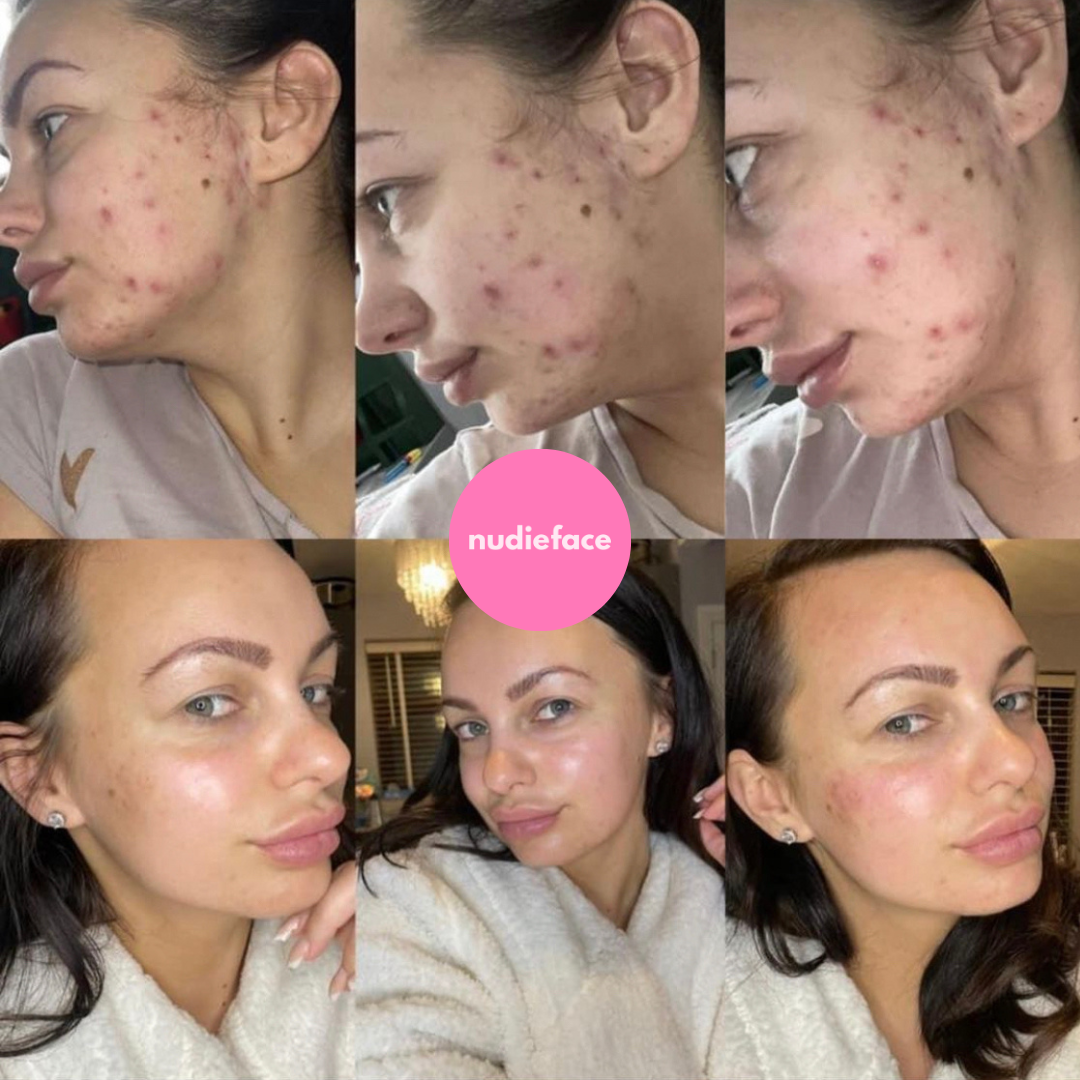 Glow Peel - At Home Chemical Peel