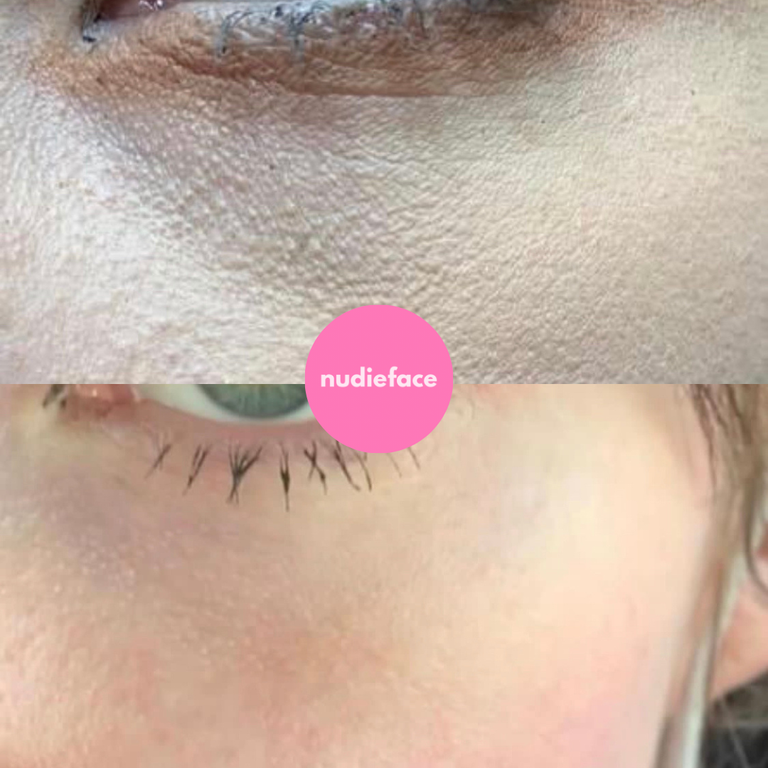 Notox - Forehead + Eyes Silicone Patches