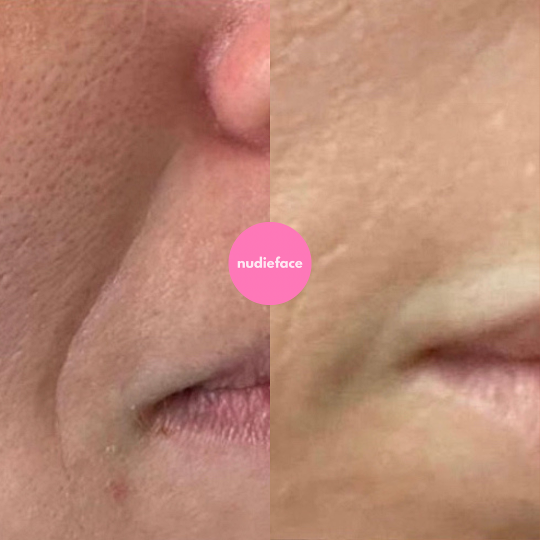 Notox - Mouth + Smile Lines Silicone Patches