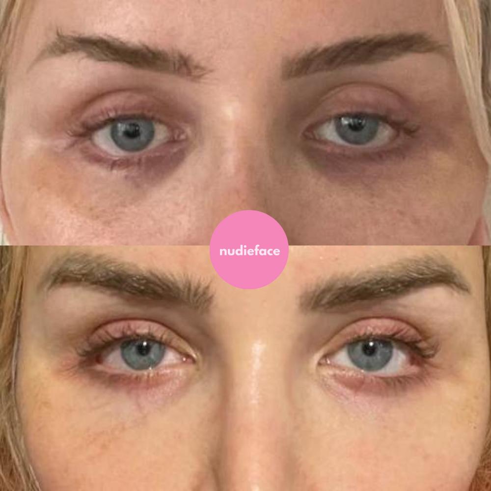 Eye Booster - Micro-Needle Patches