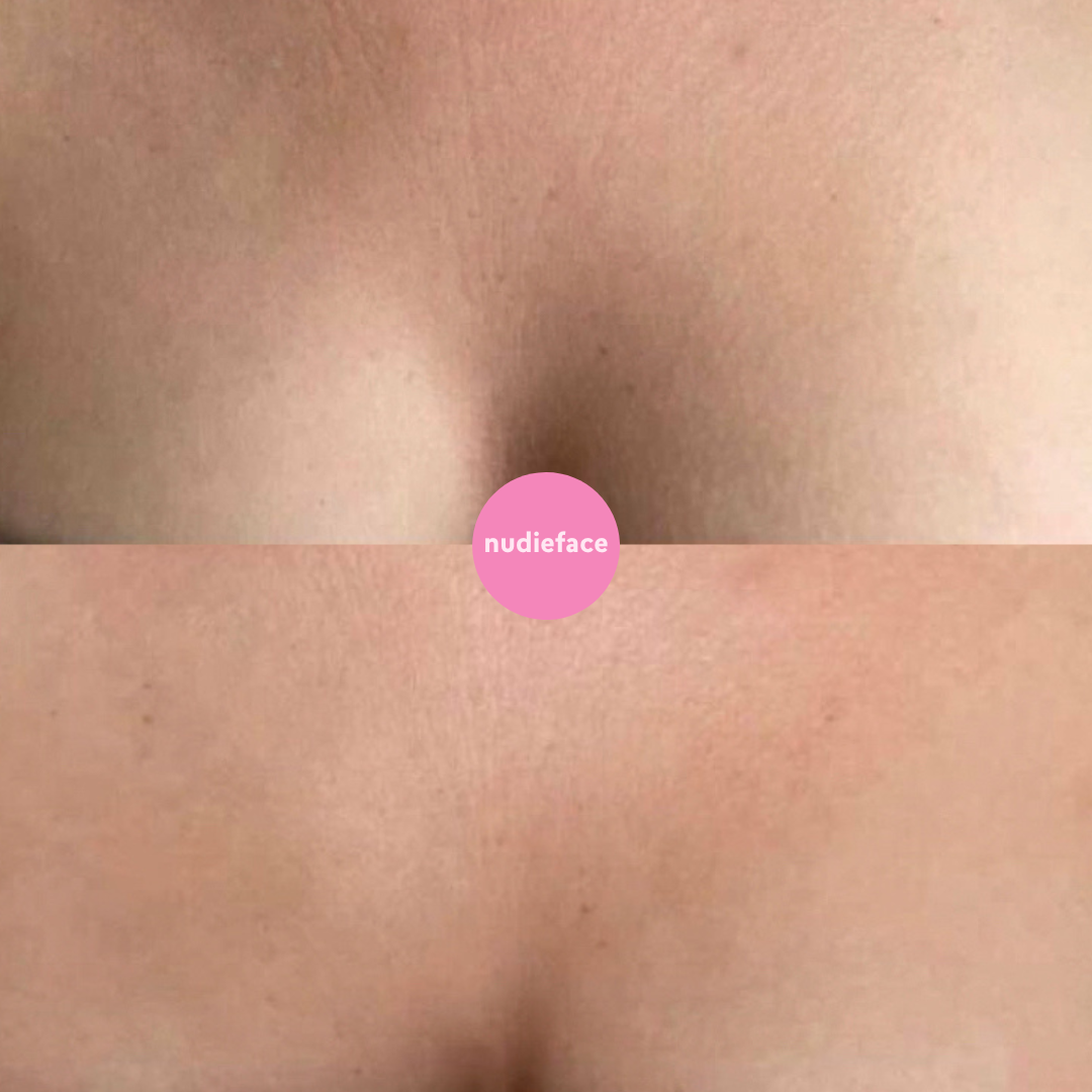 Notox - Chest + Body Silicone Wrinkle Patch